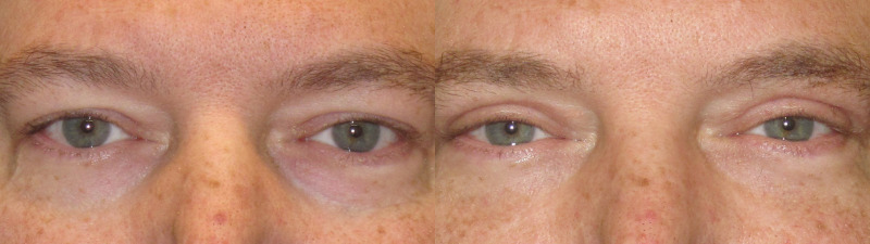 Patient 64 Combined Image