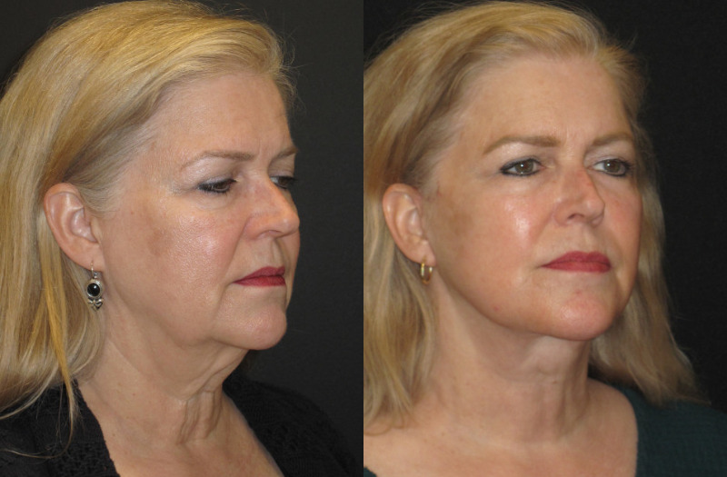 Patient 73 Combined Image