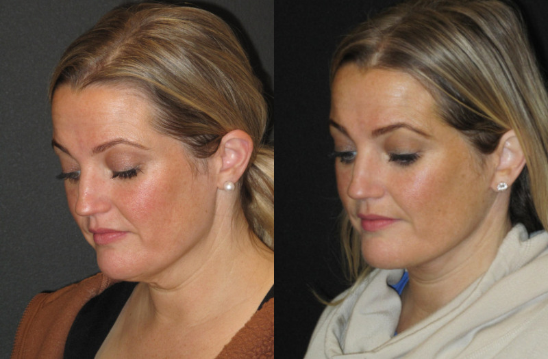 Patient 58 Combined Image