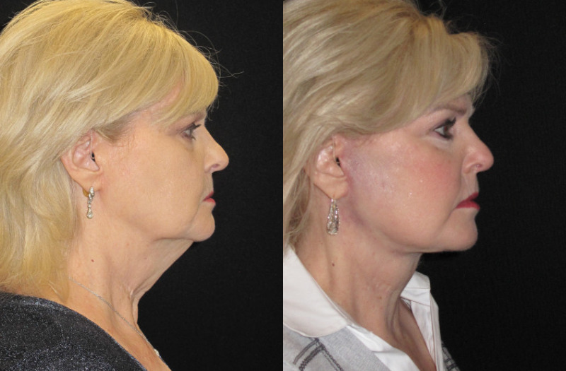 Patient 74 Combined Image