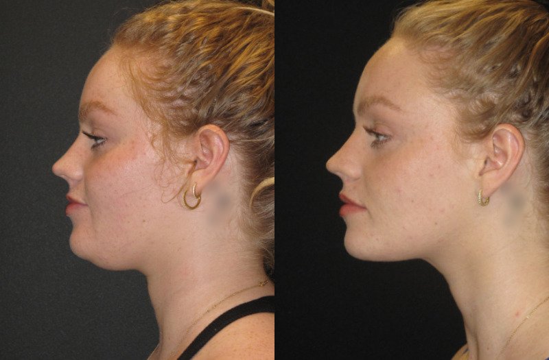 Patient 72 Combined Image