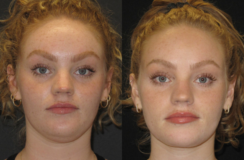 Patient 72 Combined Image