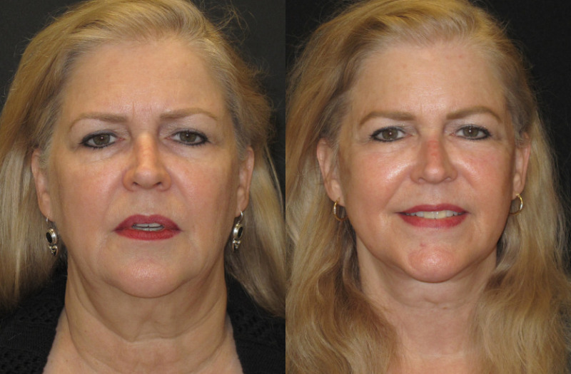 Patient 73 Combined Image