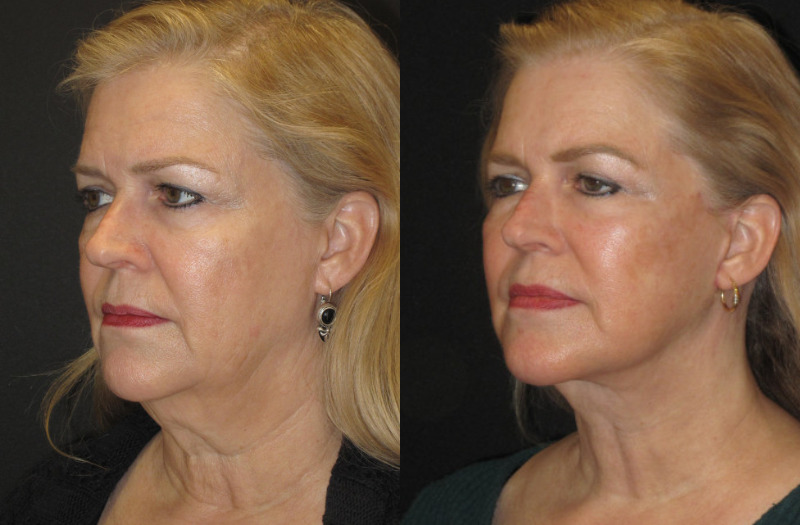 Patient 73 Combined Image