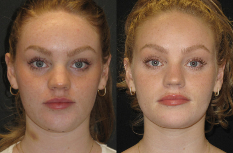Patient 72 Combined Image