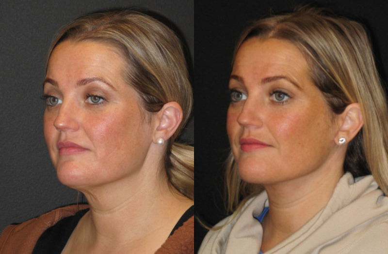 Patient 58 Combined Image