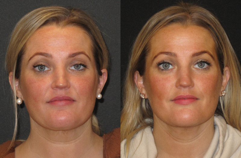 Patient 58 Combined Image