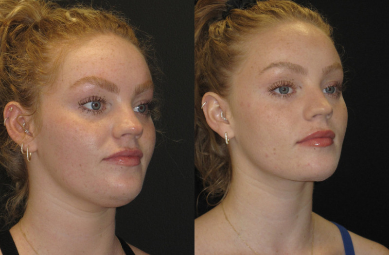 Patient 72 Combined Image