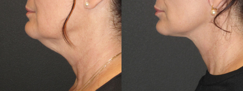 Patient 90 Combined Image