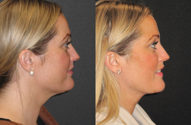 Patient 58 Combined Image