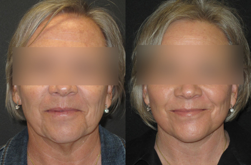 Patient 71 Combined Image