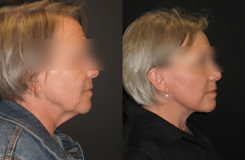 Patient 71 Combined Image