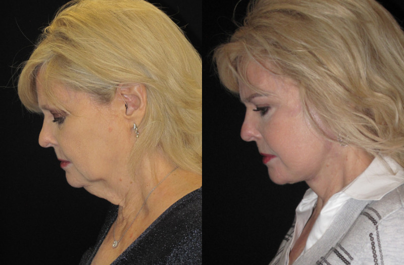 Patient 74 Combined Image