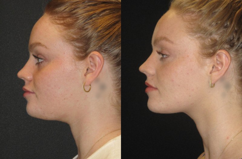 Patient 72 Combined Image