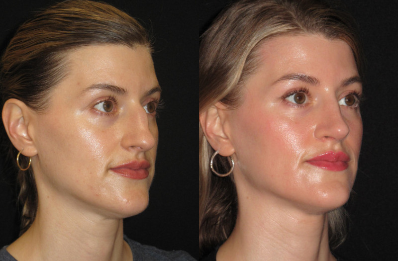 Patient 79 Combined Image