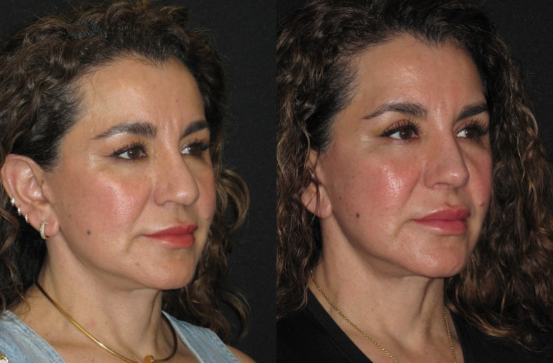 Patient 77 Combined Image