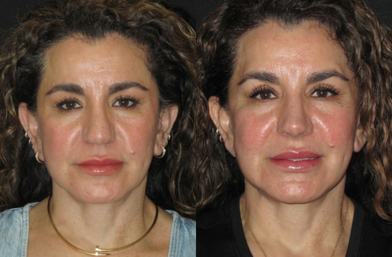 Patient 77 Combined Image