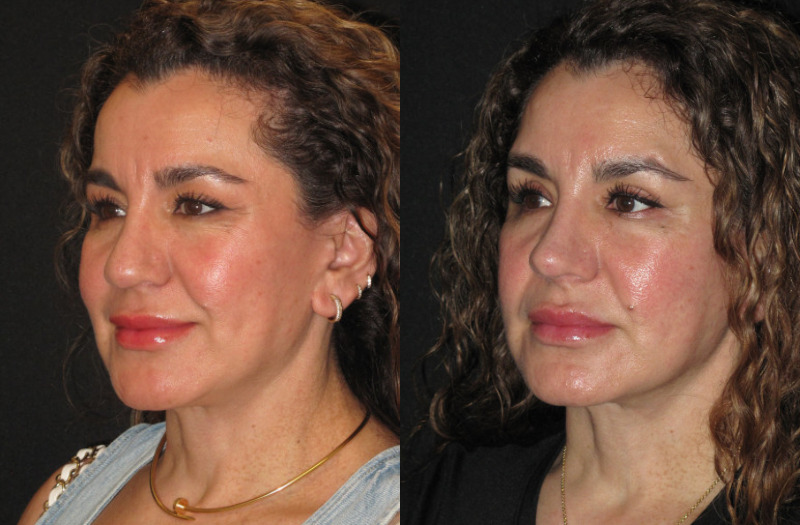 Patient 77 Combined Image