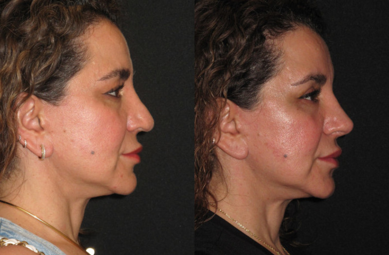 Patient 77 Combined Image