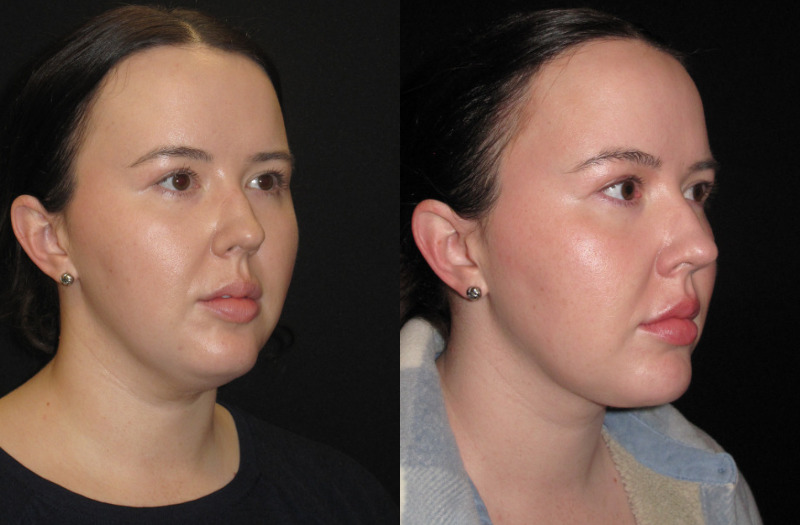 Patient 79 Combined Image