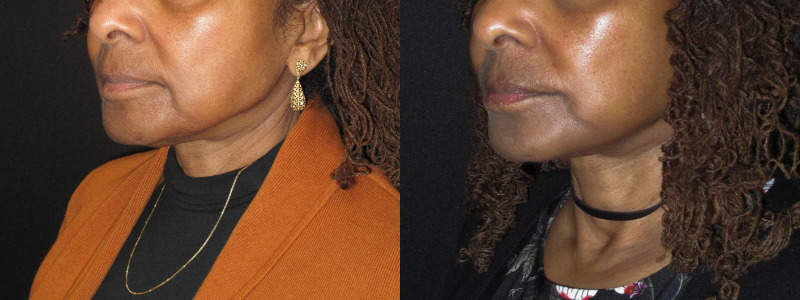 Patient 77 Combined Image