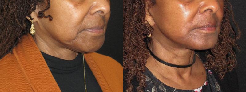 Patient 77 Combined Image