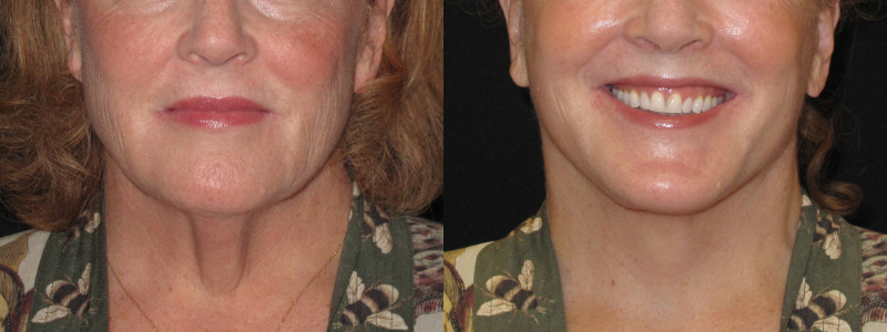 Patient 78 Combined Image