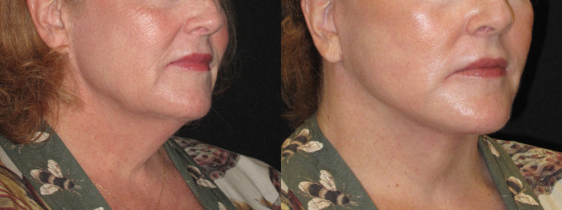 Patient 78 Combined Image