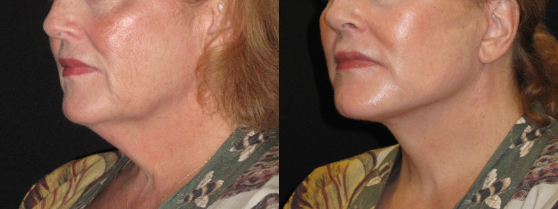 Patient 78 Combined Image