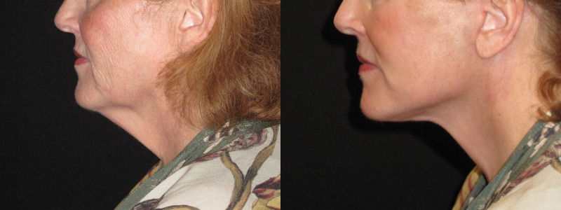 Patient 78 Combined Image