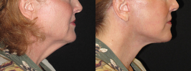 Patient 78 Combined Image