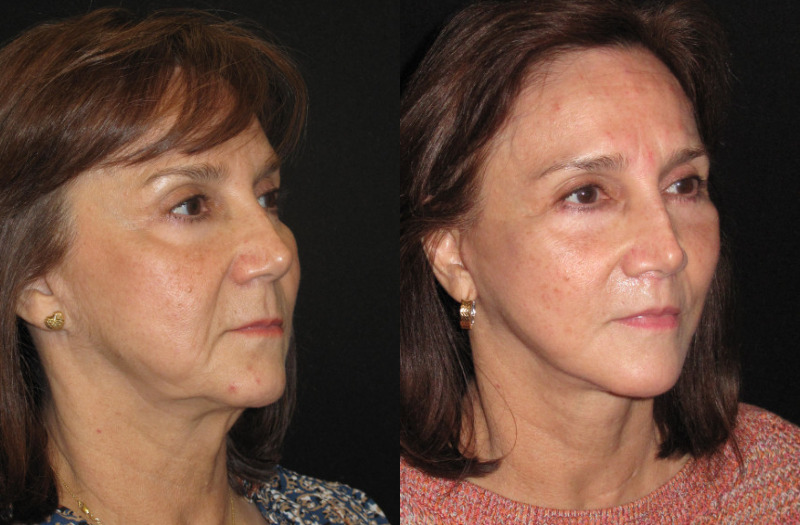 Paitent 75 Combined Image