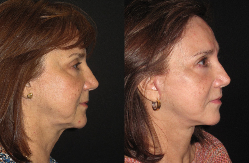 Paitent 75 Combined Image