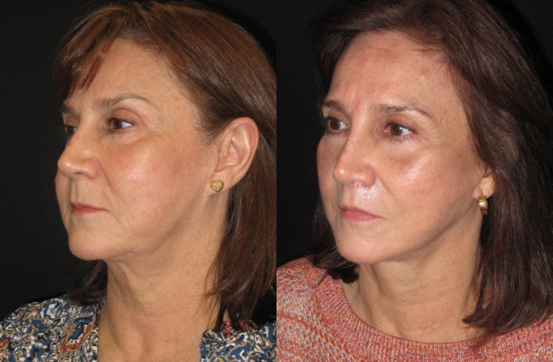 Paitent 75 Combined Image