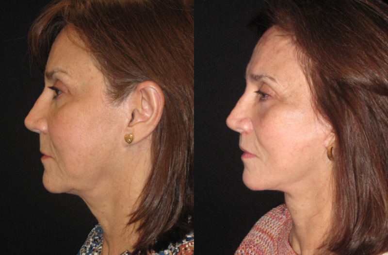 Paitent 75 Combined Image