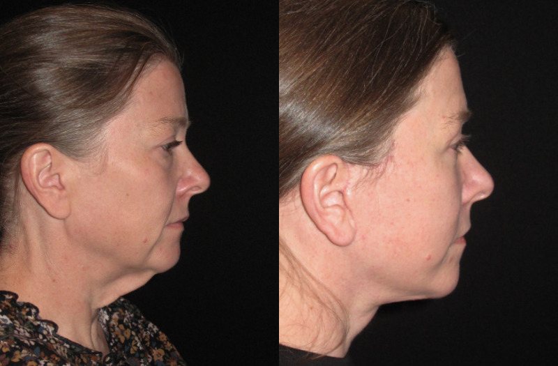 Patient 80 Combined Image