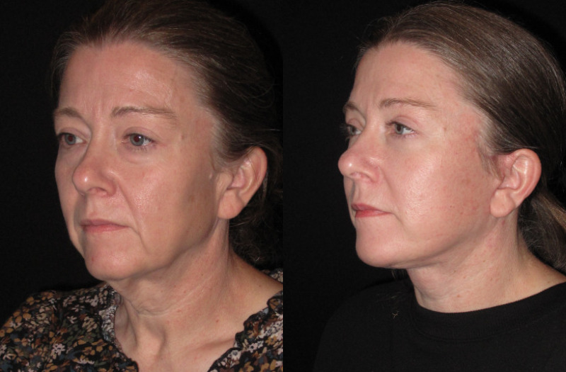 Patient 80 Combined Image