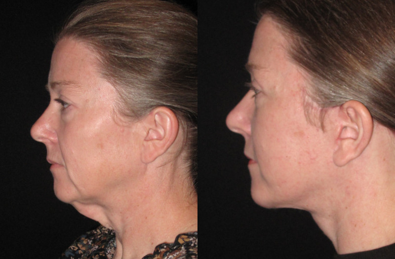 Patient 80 Combined Image