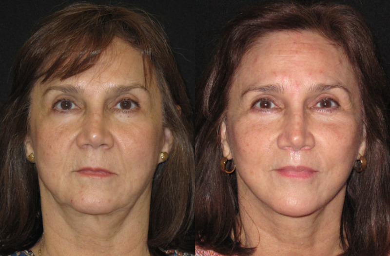 Paitent 75 Combined Image