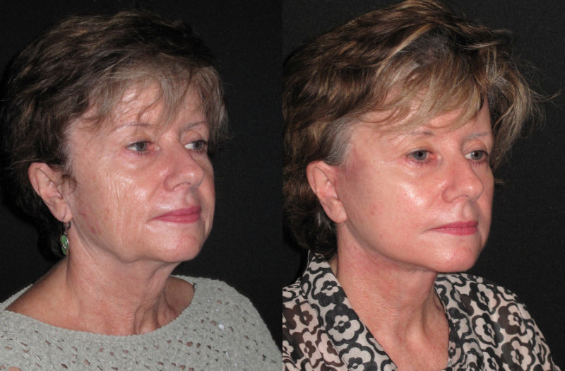 Patient 85 Combined Image