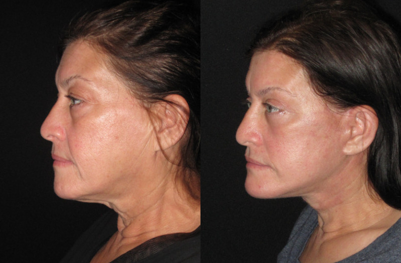 Patient 86 Combined Image