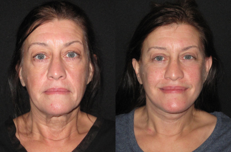 Patient 86 Combined Image