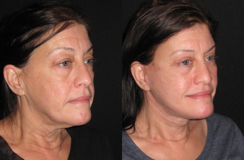 Patient 86 Combined Image