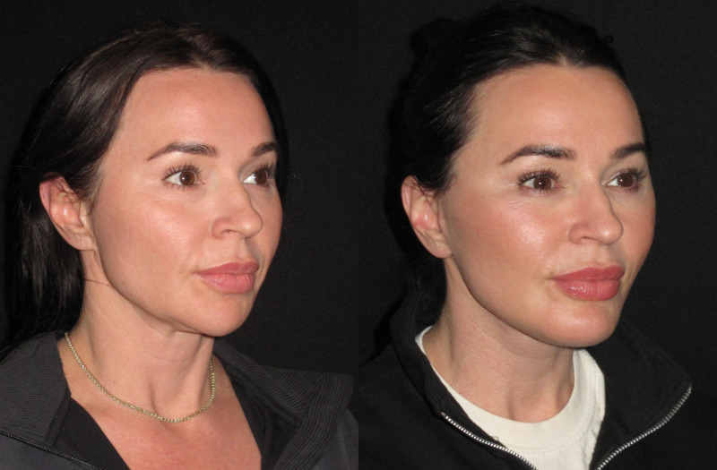 Patient 87 Combined Image