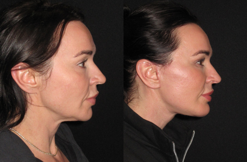 Patient 87 Combined Image