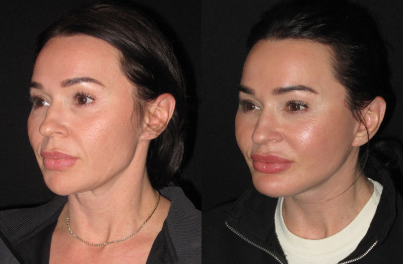 Patient 87 Combined Image