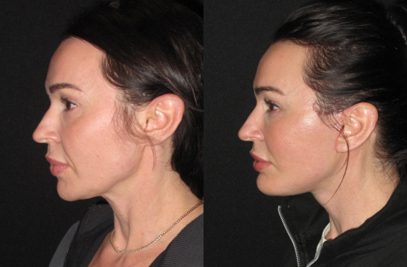 Patient 87 Combined Image