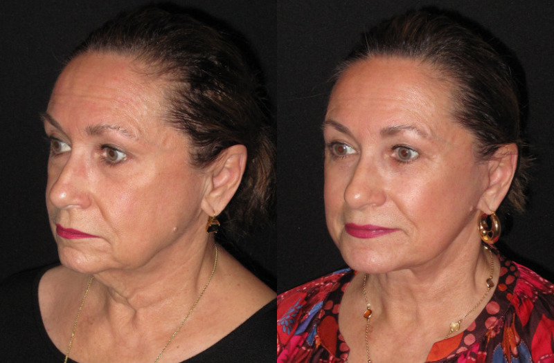 Patient 88 Combined Image