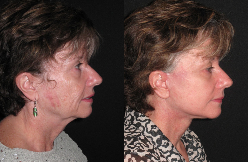 Patient 85 Combined Image