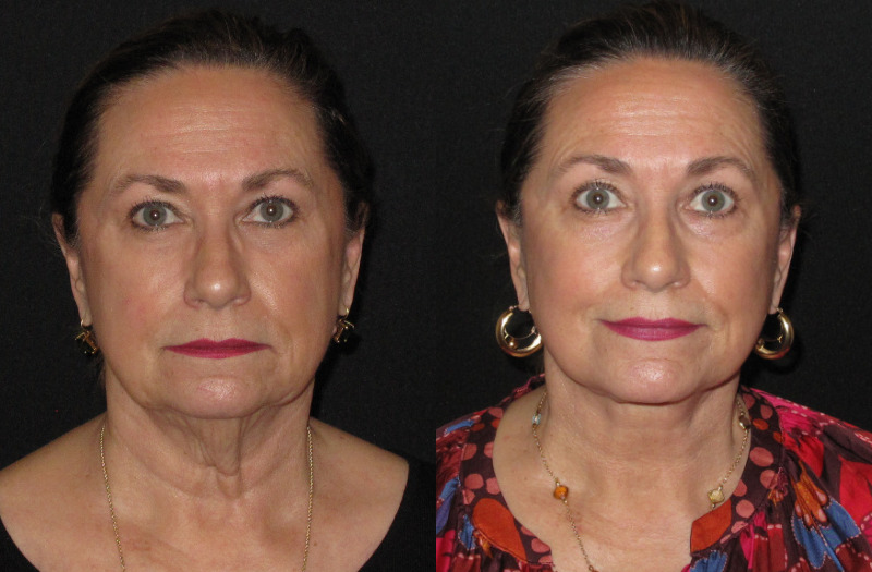 Patient 88 Combined Image